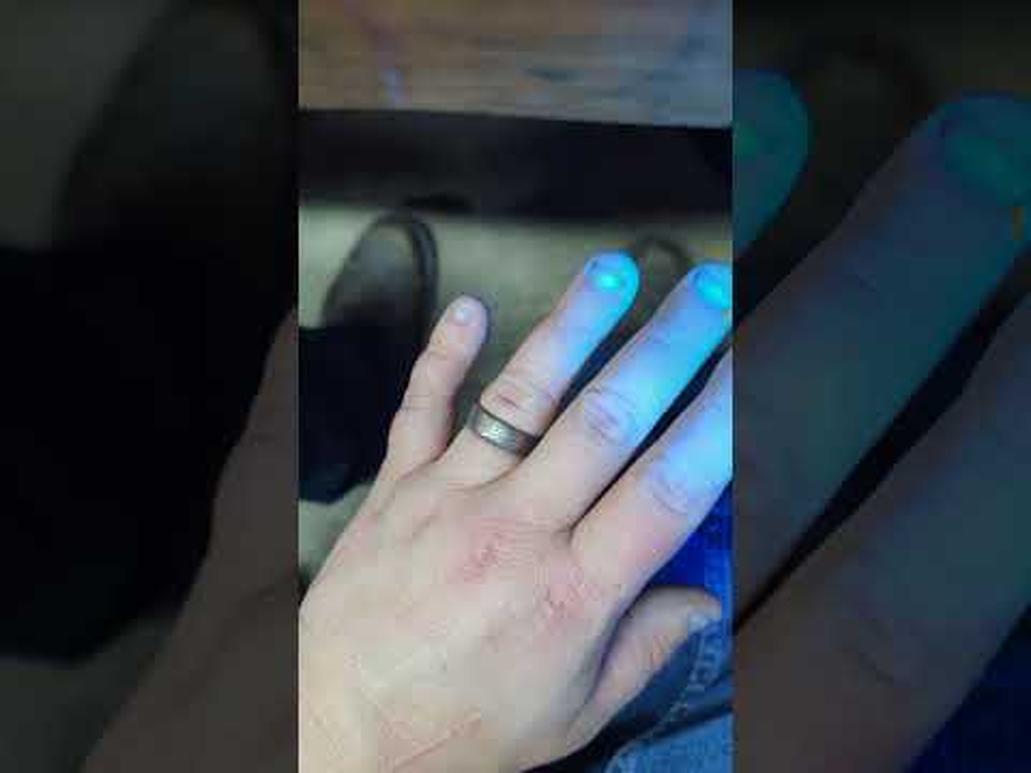 If you're wondering why your skin is still sporting that mysterious dark stain from silver nitrate after almost a week, it's because silver nitrate is a photoreactive compound that bonds with your skin cells and simply won’t wash off right away.This isn’t some stubborn dye or dirt — it’s a chemical transformation that’s meant to last several days or even weeks. Intrigued? Keep reading to find out why, how it happens, and how to handle it next time.