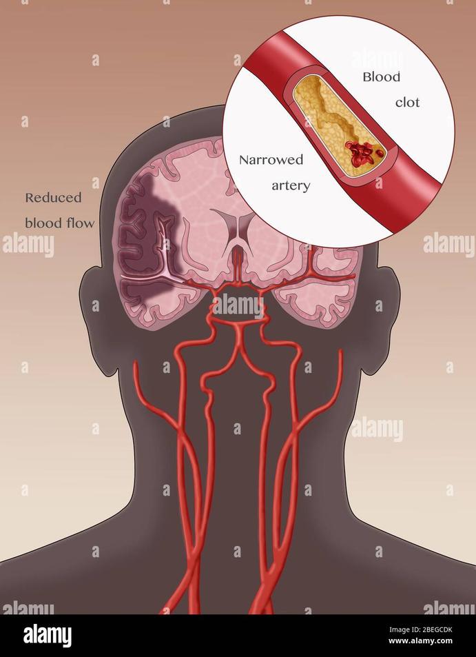 The ATP Crisis: Why Ion Transport Stumbles in Ischemia