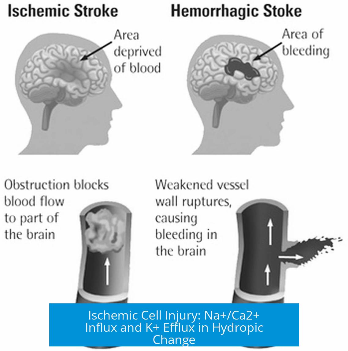 Ischemic Cell Injury: Na+/Ca2+ Influx and K+ Efflux in Hydropic Change
